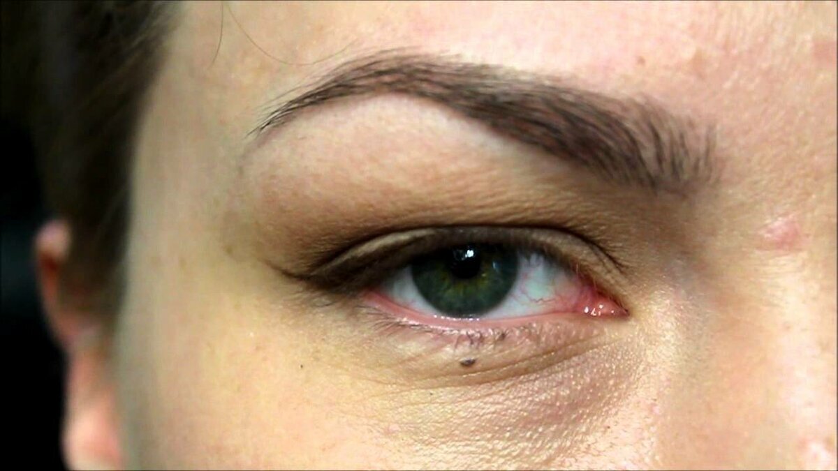 нависшее верхнее веко