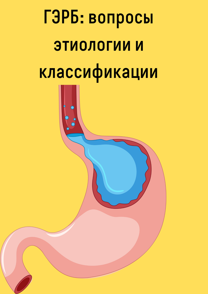 Дуодено гастральный рефлюкс недостаточность кардии. Дуодено-гастральный рефлюкс желчи.