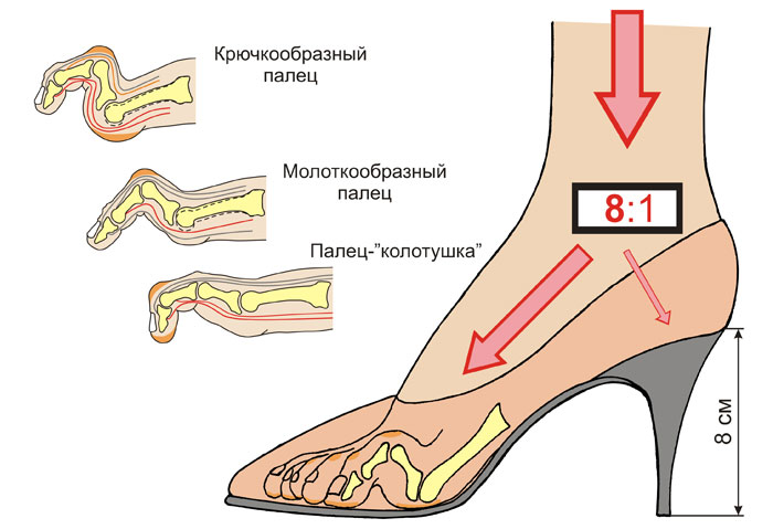 Источник : https://kost-shirokaya.ru/zdorovie/kabluki-vred/#i