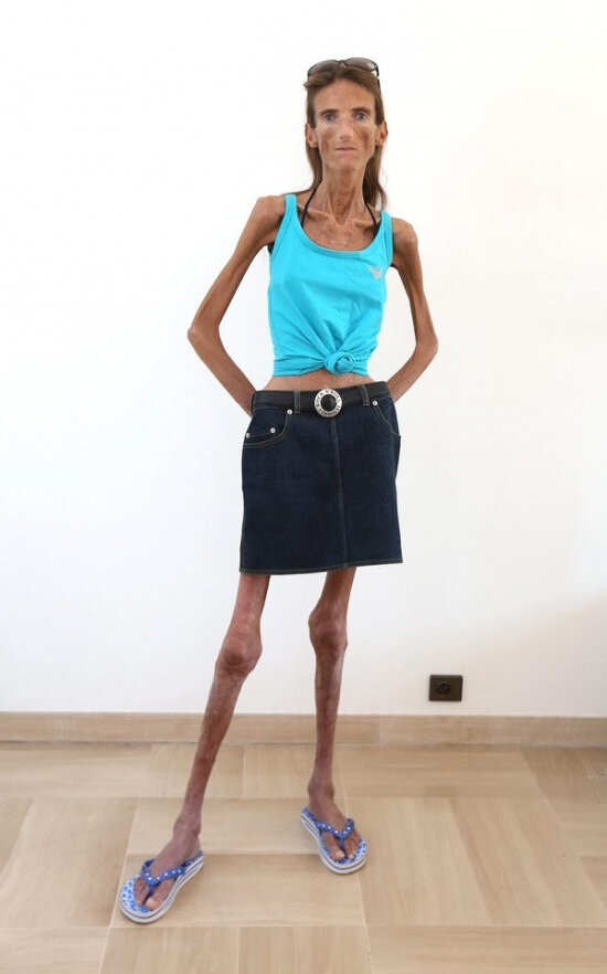 Самая худая женщина в мире (11 фото)