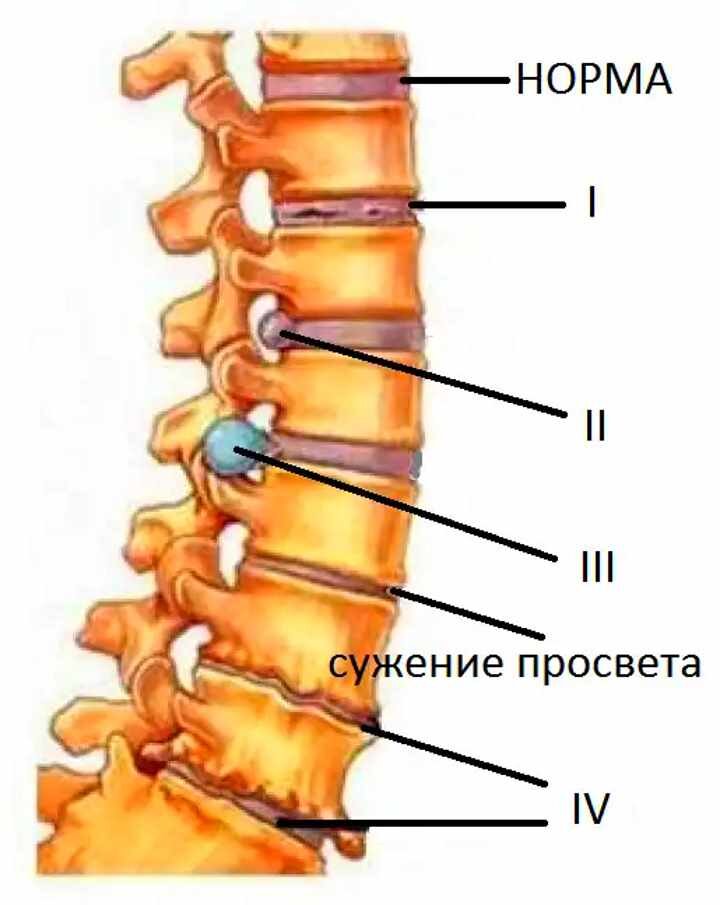 Развитие остеохондроза