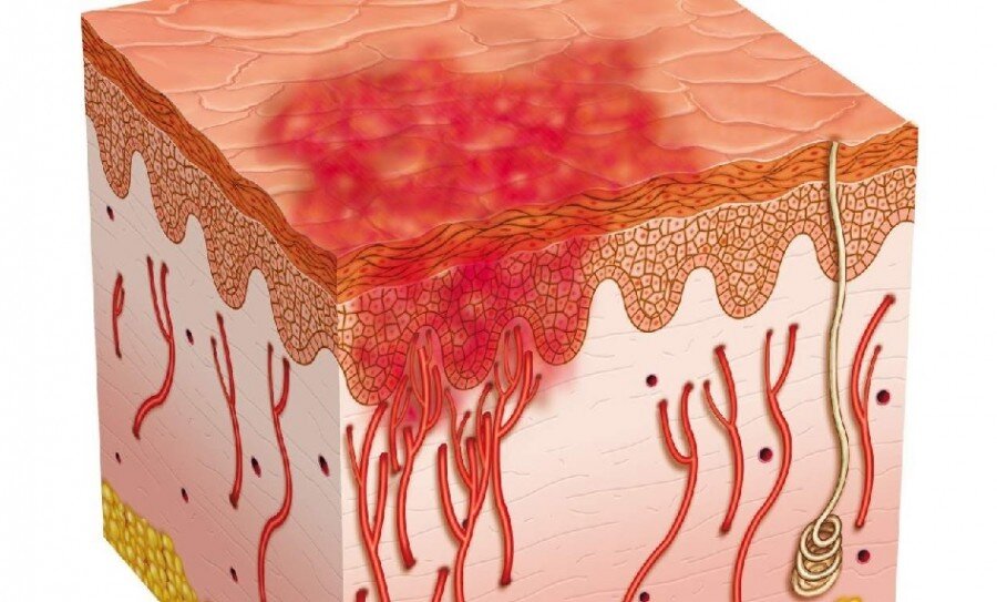 Морфологические элементы кожи. Меланоциты эпидермиса кожи. Первичные морфологические элементы кожи пузырь. Пятно дерма. Псориатическая папула.