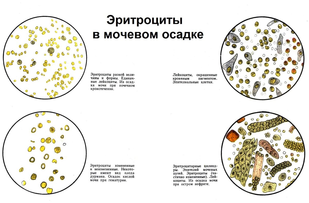 как выглядит осадок в моче | Дзен