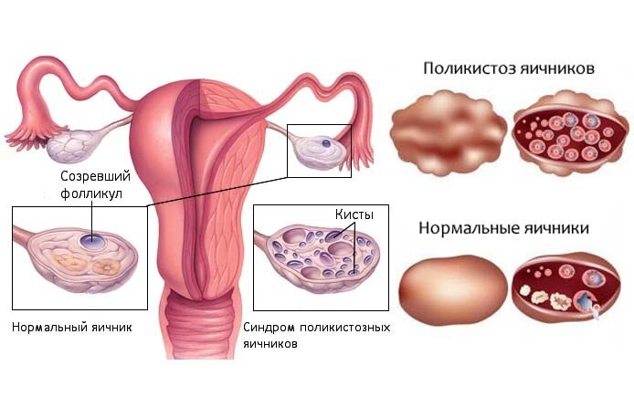 Мультифолликулярные яичники - 30 ответов - Планирование беременности - Форум Дети дачник-4.рф