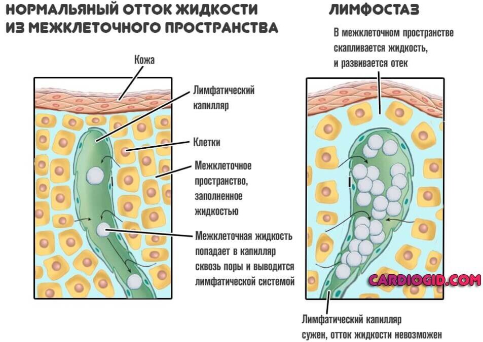 Застой лимфы лечение препараты. Лимфа и межклеточная жидкость. Отек в межклеточном пространстве. Нарушение оттока лимфатической жидкости. Лимфатические отеки лимфатические ног.