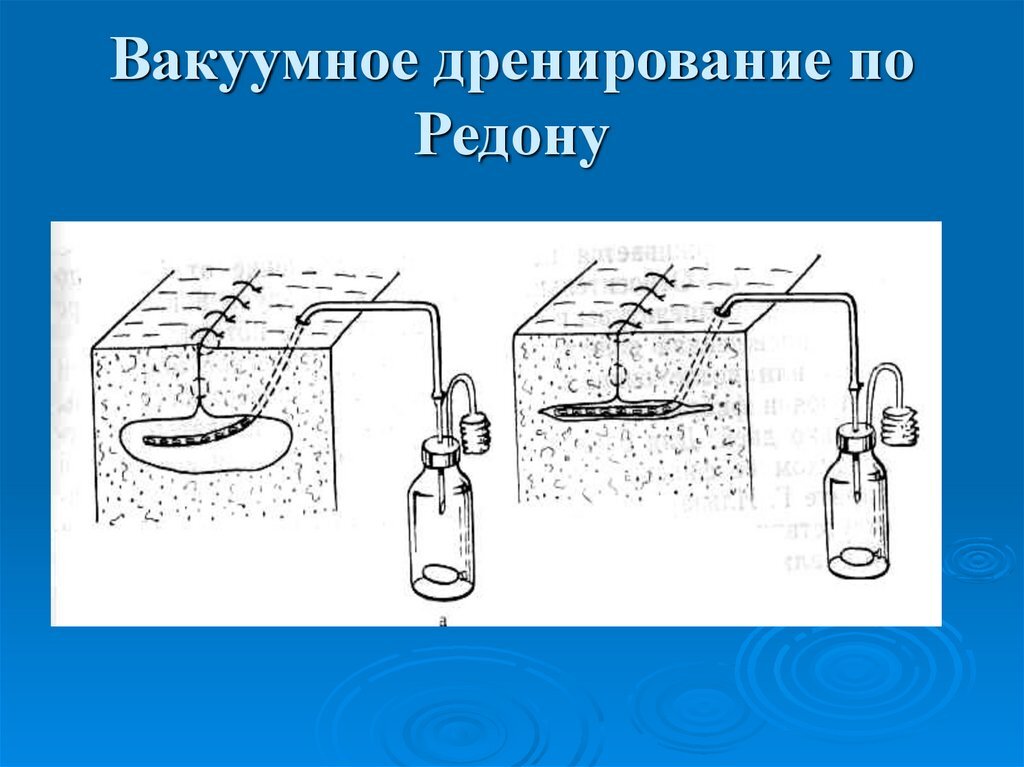 Фото с сайта https://laser-estet.ru/foto/chto-takoe-drenirovanie-podkozhnoj-kletchatki.html 