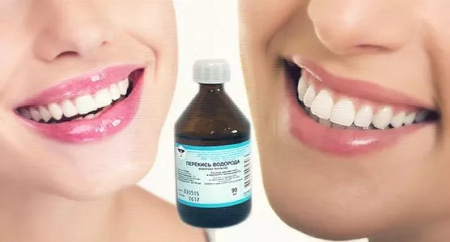 Полоскать рот после чистки. Отбеливание зубов перекисью. Отбеливание перекисью зубы. Перекись водорода для зубов. Отбеливание перекисью водорода.