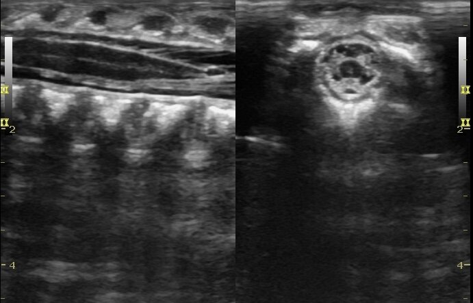 Фото результатов УЗИ шейного отдела позвоночника младенца.