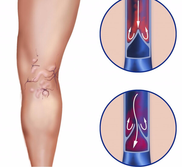 Что нельзя делать при варикозном расширении вен?