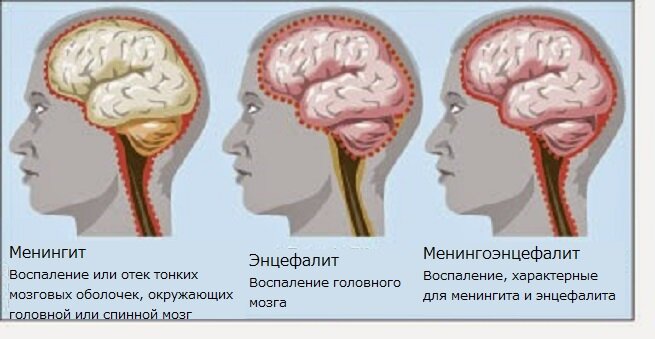 Бактериальный менингит - симптомы, признаки, лечение