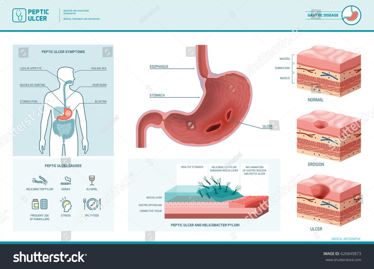 https://www.shutterstock.com/image-vector/peptic-ulcer-helicobacter-pylori-infographic-symptoms-626849873