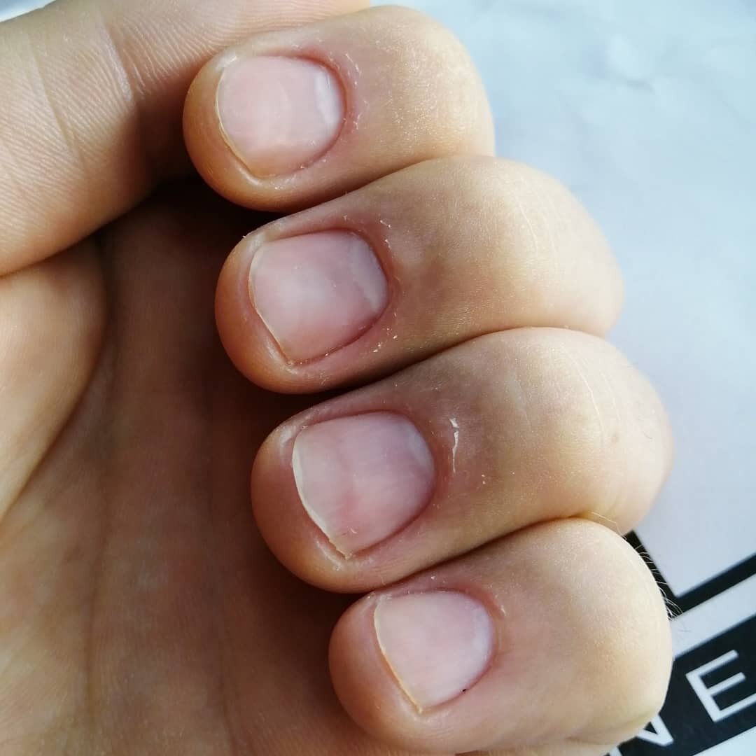 Результат. Фото сделано через час после процедуры. 

