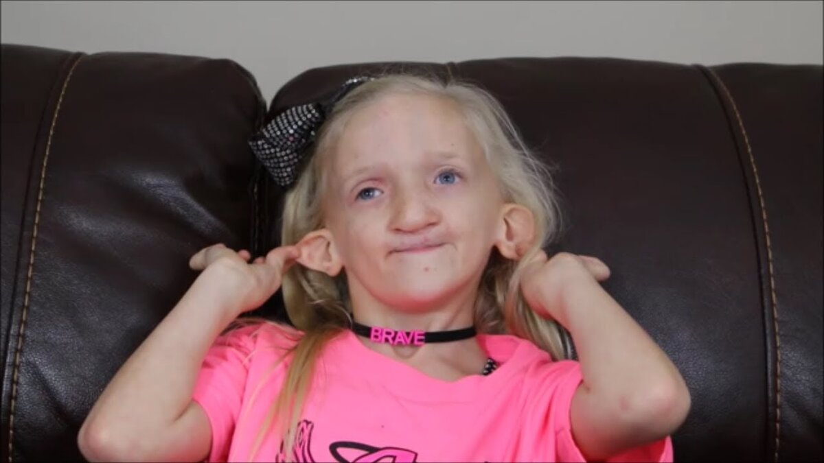 Ребенок с синдромом Антли - Бикслера 