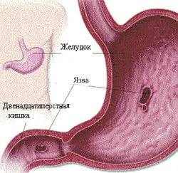 И бывает в разных местах желудка, но чаще в 12 перстной кишке
