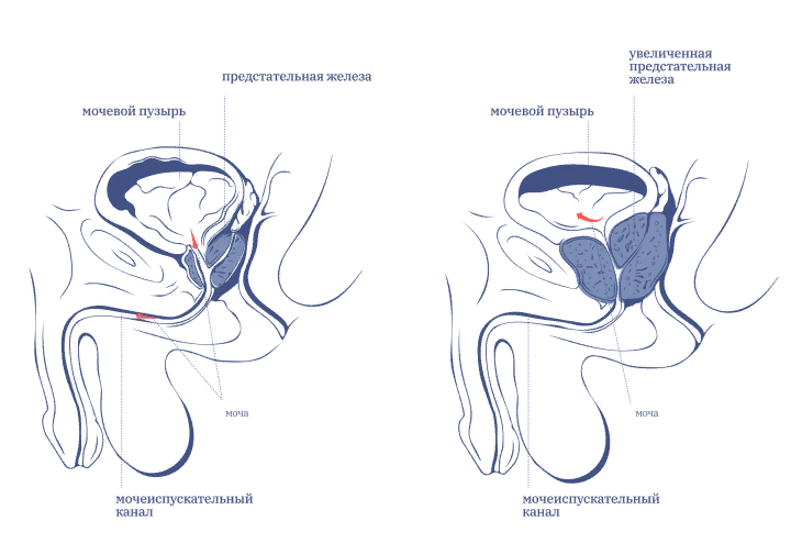  
Отток мочи при нормальной (слева) и увеличенной (справа) простате