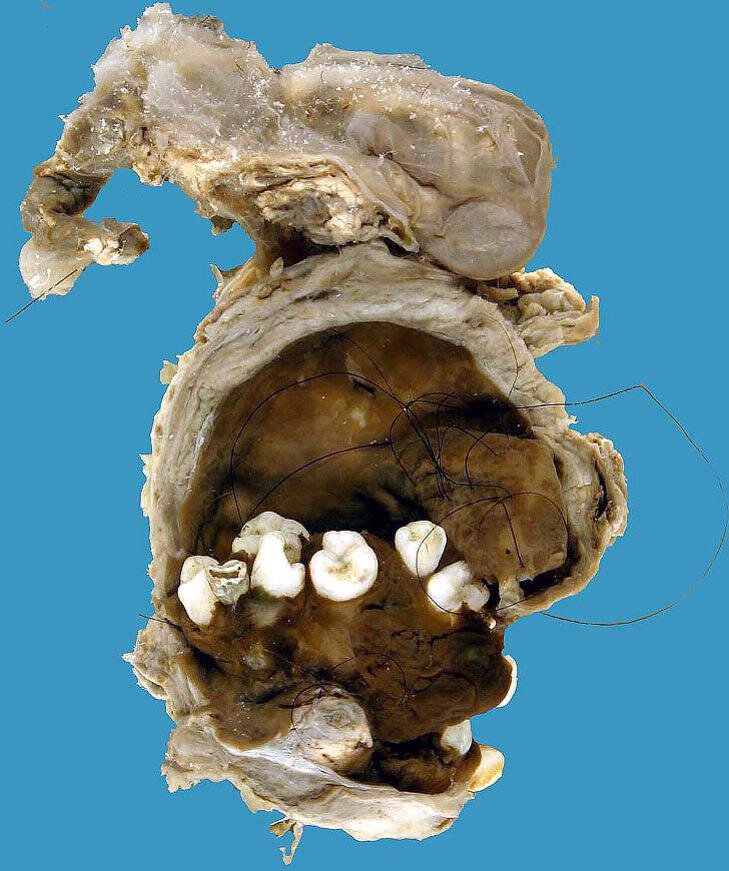 Еще одна тератома, только с зубами.