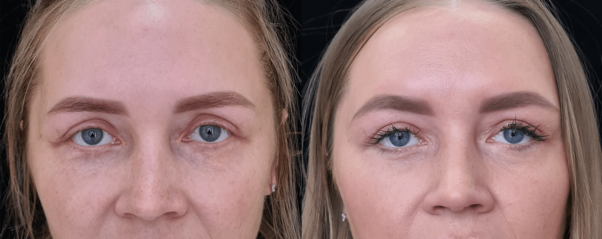 Восстановление век после ранее проведённой блефаропластики фото до и после. Фото предоставлено Д.Р. Гришкяном. Имеются противопоказания, требуется консультация специалиста