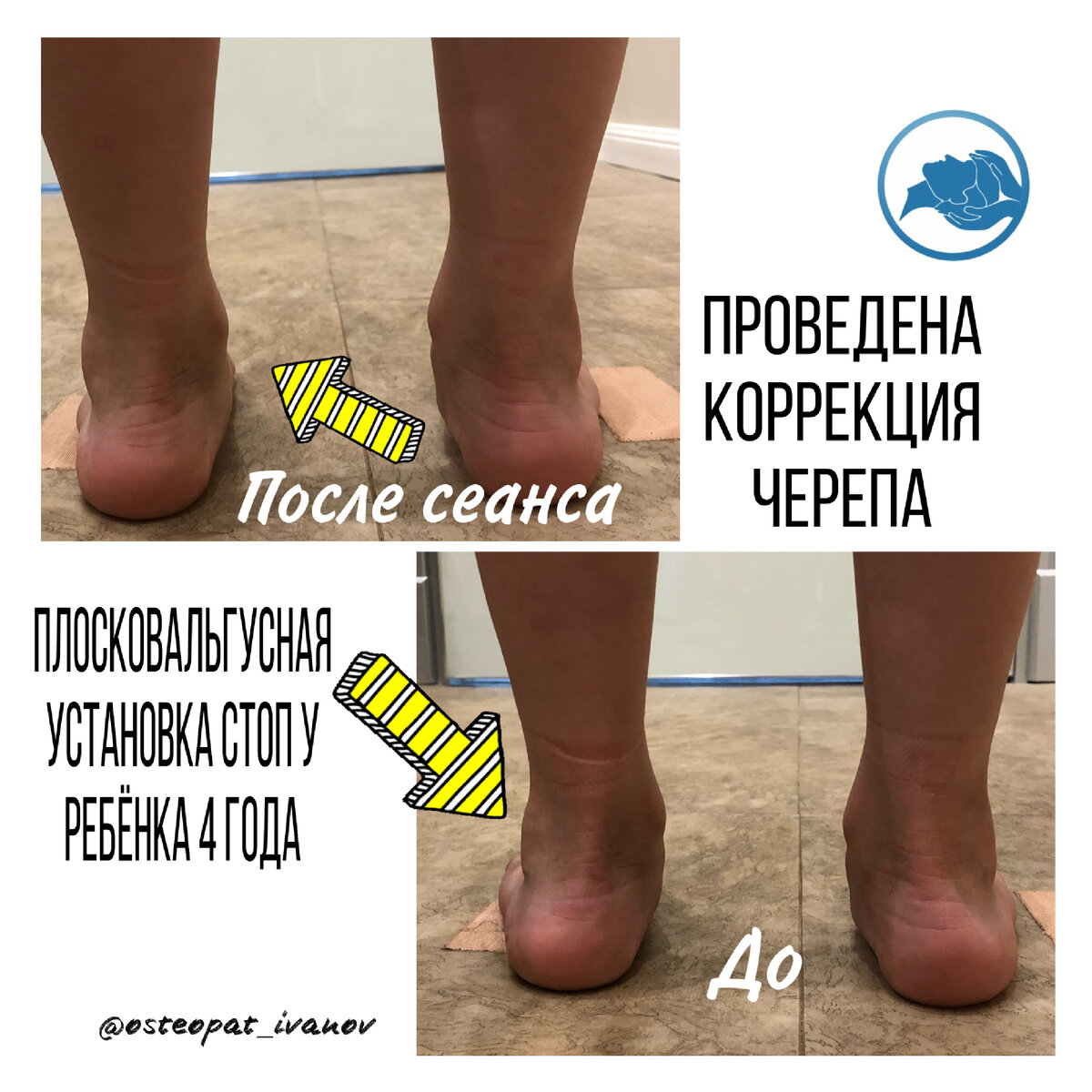 Краниосакральная терапия при дисплазии 