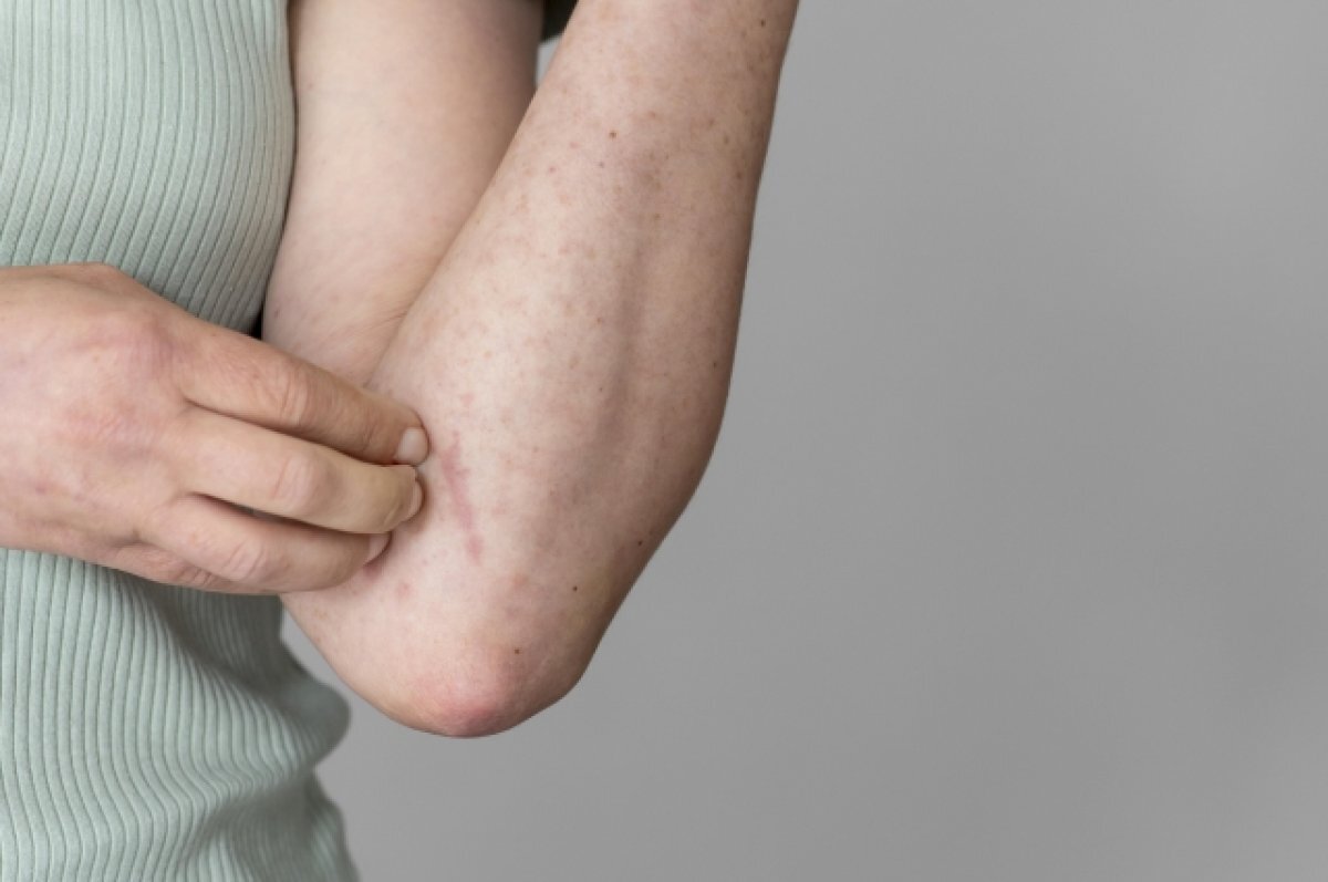    В Новом Уренгое зафиксированы случаи заболевания корью