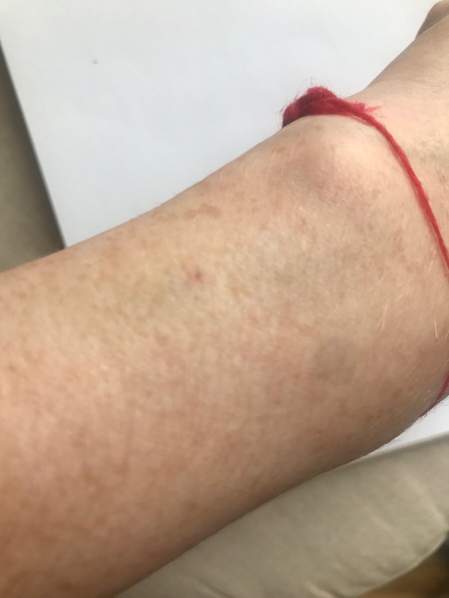 (за день до сдачи крови ставили катетер для ввода контраста, осталась только точка)