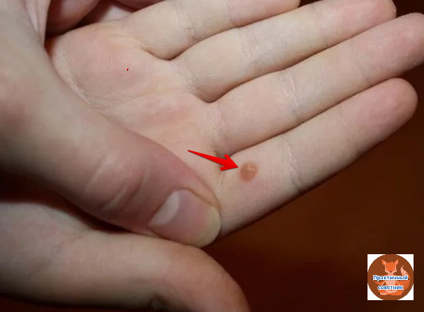 Бородавка на руке