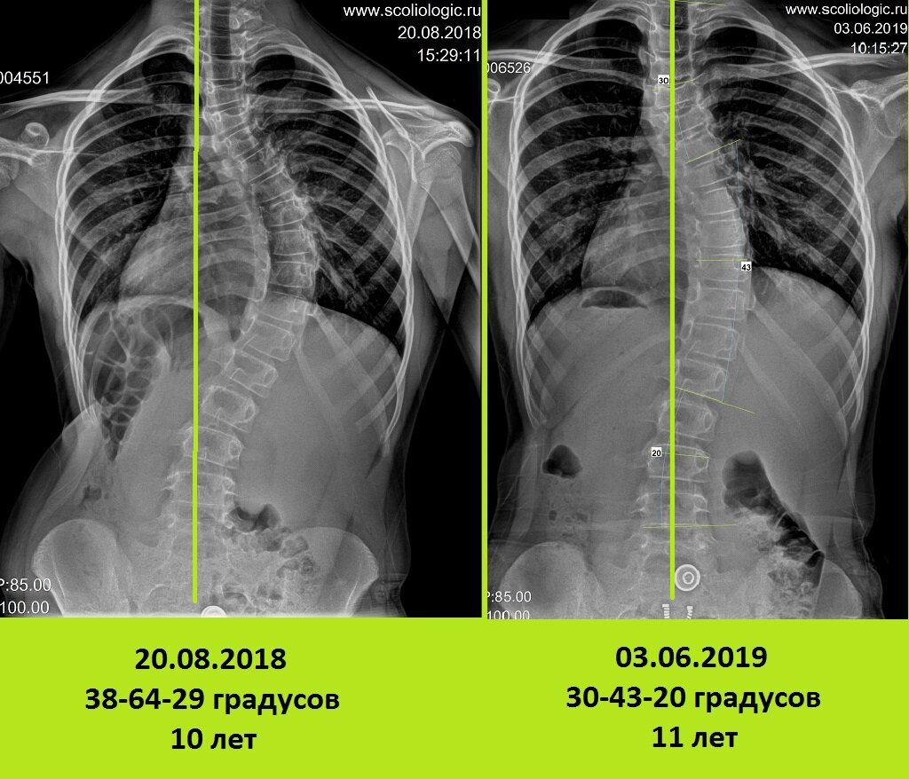 Лечение сколиоза и результат! | Протезно-ортопедический центр | Дзен