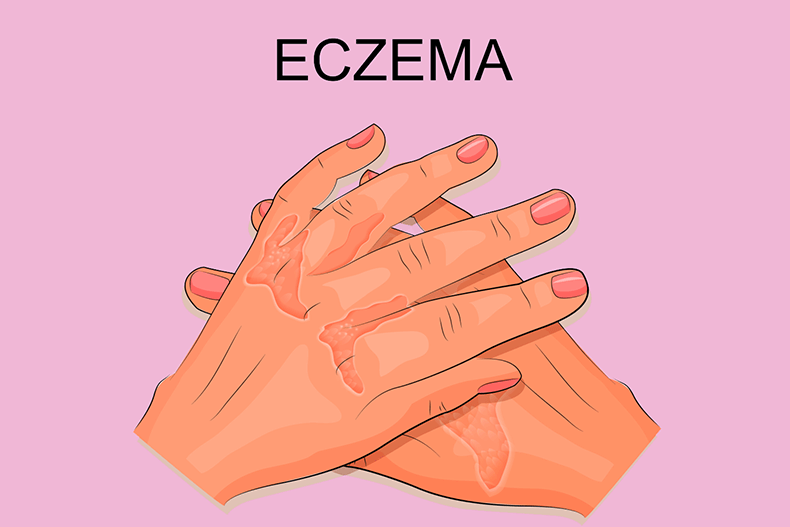 Экзема: Лечение при помощи натуральных средств