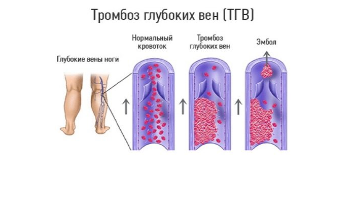 Как выглядит тромбоз вен на ногах