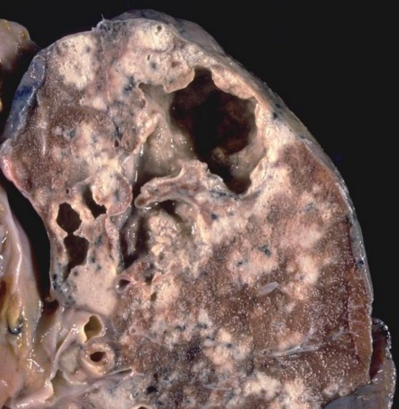 Развитие туберкулеза в почках