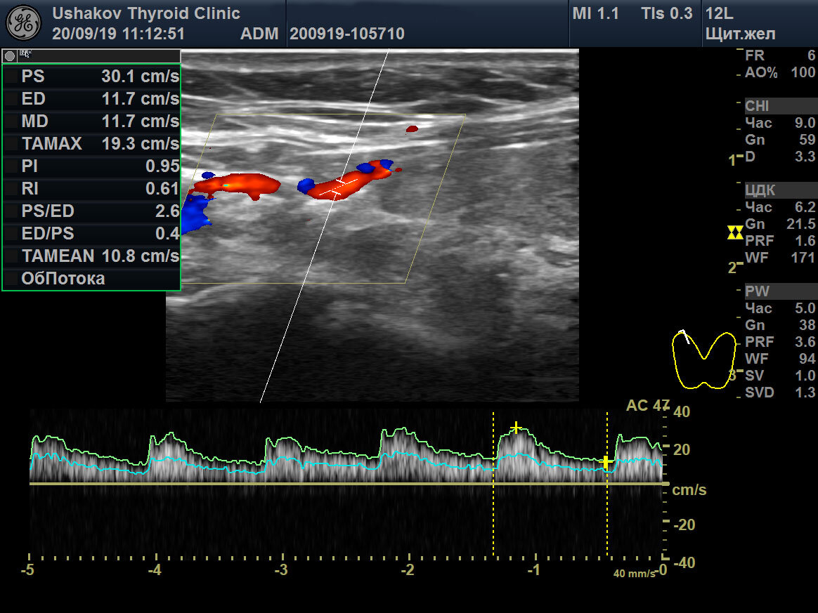 Кровоток в щитовидной железе