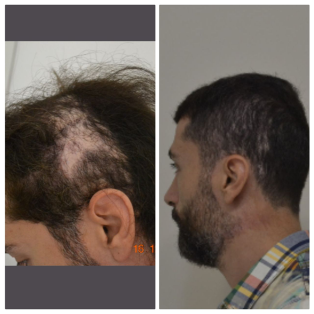 Волосы после пересадки волос. Операция по пересадке волос. Схема бороды мужской. Мужчины после пересадки волос. Крестьянская застава метро схема.