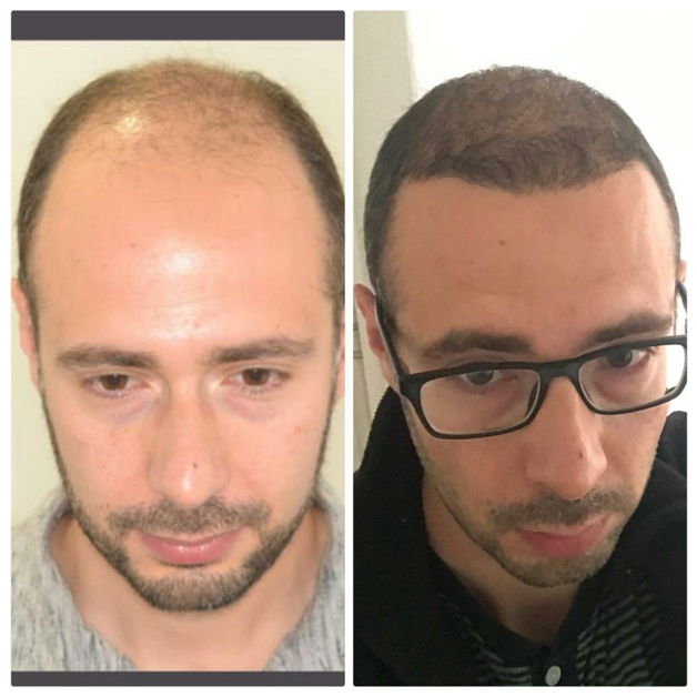 Трансплантация волос до и после. До и после пересадки волос. Бебуришвили пересадка волос