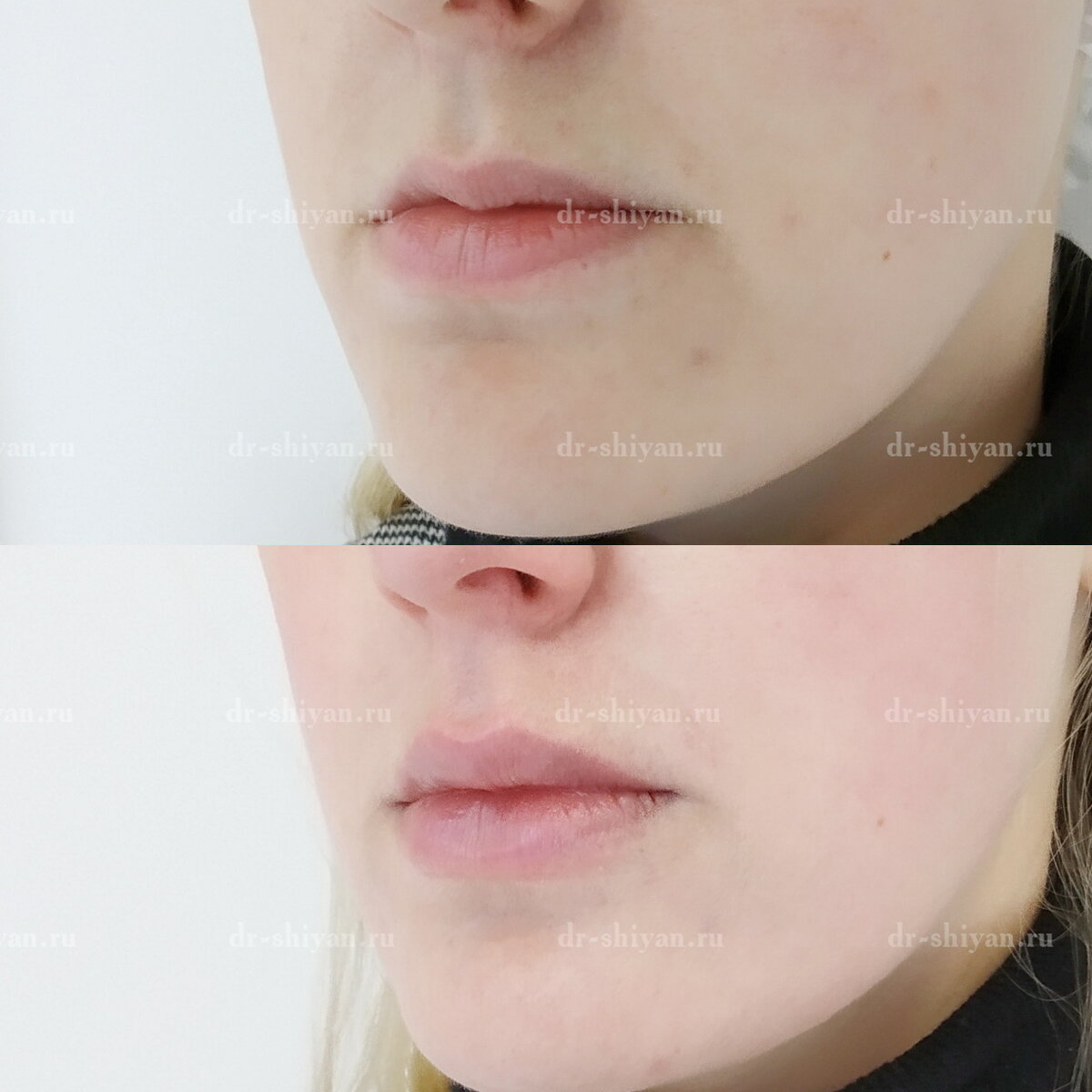 БЬЮТИФИКАЦИЯ ГУБ - «ДО И ПОСЛЕ»