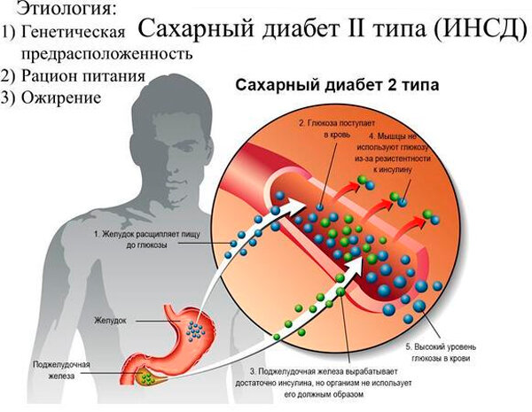 Сахарный диабет: причины, симптомы, лечение