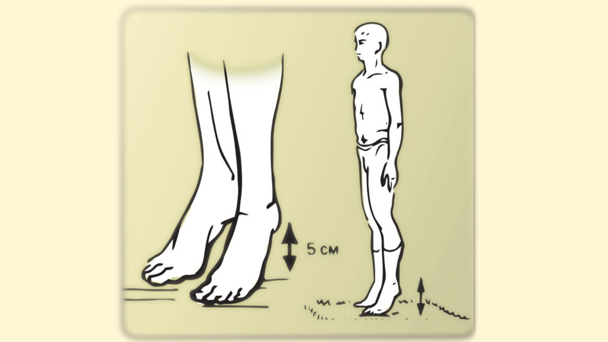 Лимфодренажные прыжки по Микулину. Отличие в том, что ударяем пятками о пол не быстро, а один раз в секунду. 1 сек. = 1 удар пяткой. Стучим 30 раз, отдыхаем 15 секунд и так повторяем до 90 раз.