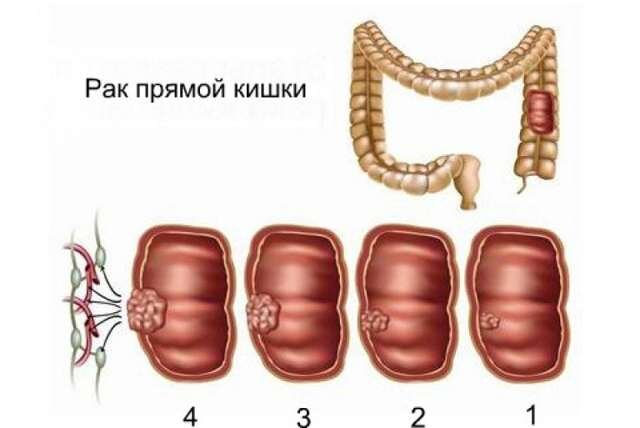 Рак кишечника. С какими симптомами нужно срочно бежать к врачу