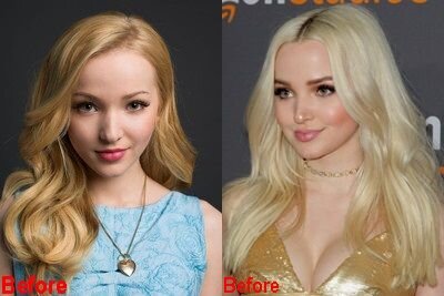 Дав Камерон до и после пластики.