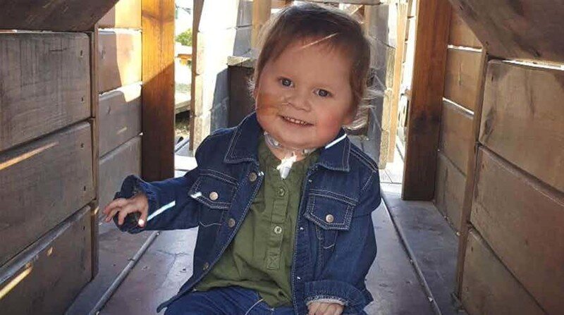 Эта девочка родилась с редчайшим дефектом - Ectopia Cordis, или внешнее расположение сердца. Сердце Киран расположено вне тела. Усугубляется это тем, что и печень у девочки находится снаружи - невероятно редкое сочетание! Как правило, такие дети не живут и года, но благодаря тщательному уходу и медицинскому наблюдению Киран живет и неплохо себя чувствует. Недавно ей исполнилось два года. 