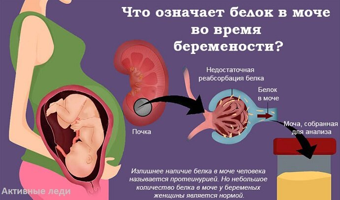 Белок в моче при беременности