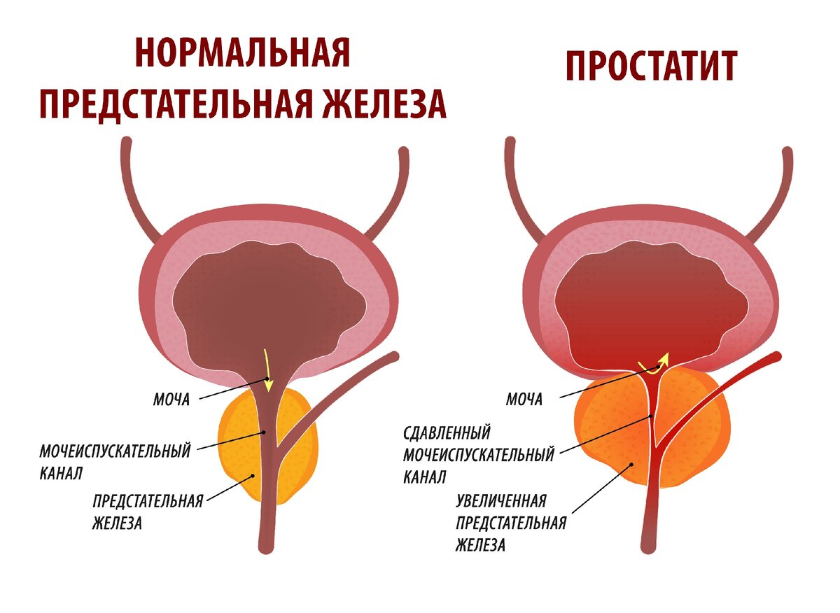 после простатита нет спермы фото 14