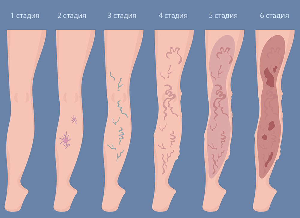 Причины расширенных вен. Варикозное расширение вен на ногах. Трофические язвы варикоз. Варикозное расширение вен стадии. Варикоз расширение вен нижних конечностей.