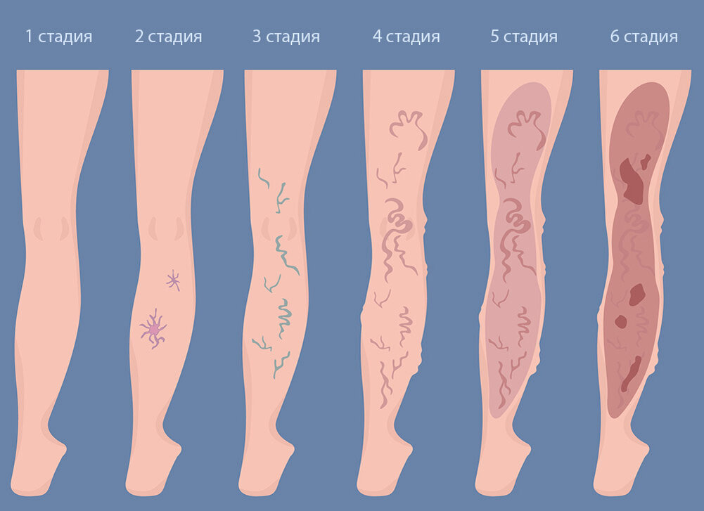 Вены на ногах что делать. Варикоз расширение вен нижних конечностей. Варикозное расширение вен нижних конечностей 1-2 степени. Варикозное расширение вен начальная стадия. Варикозное расширение вен (ВРВ) нижних конечностей.