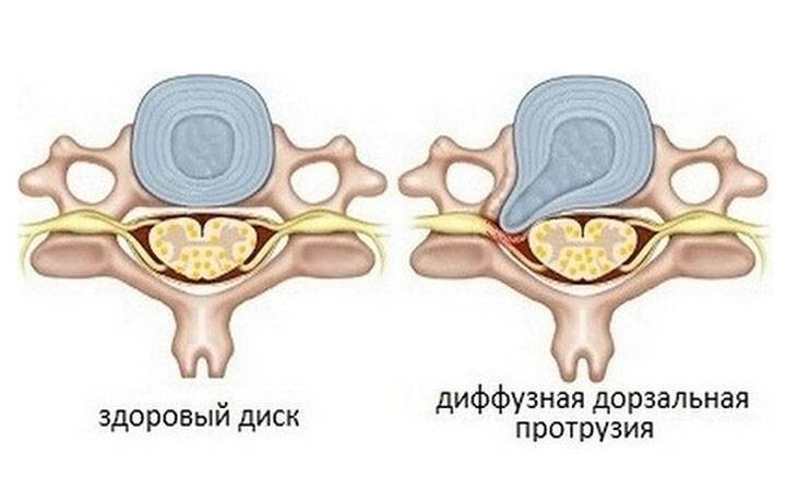 Вот именно две протрузии такого вида есть в моем поясничном отделе.