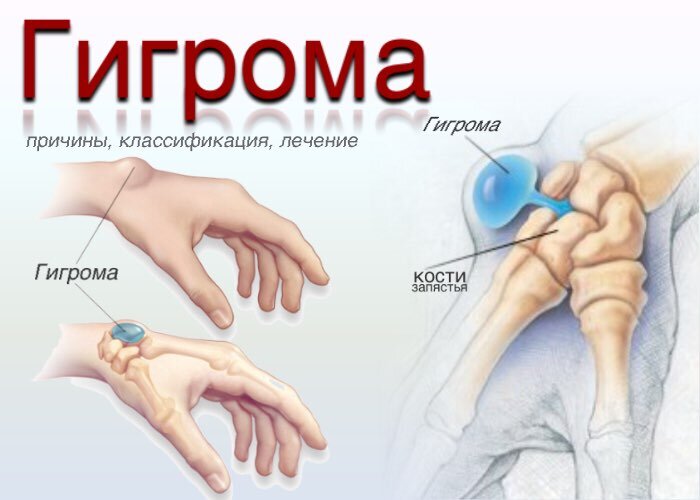 Гигрома - симптомы, причины появления, диагностика, лечение