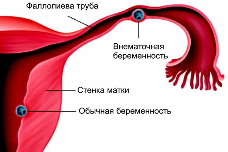 Внематочная беременность - это когда оплодотворенная яйцеклетка развивается вне матки. Обычно это происходит в одной из фаллопиевых труб, которые ведут от яичников к матке.