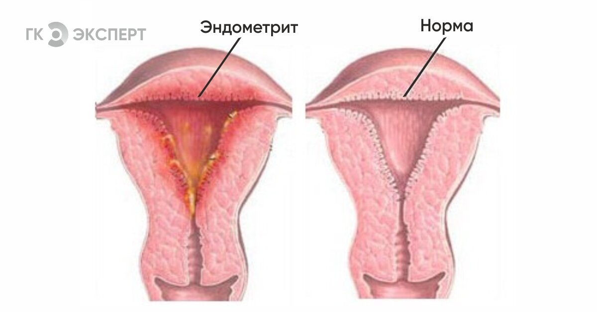 Со эндометрий