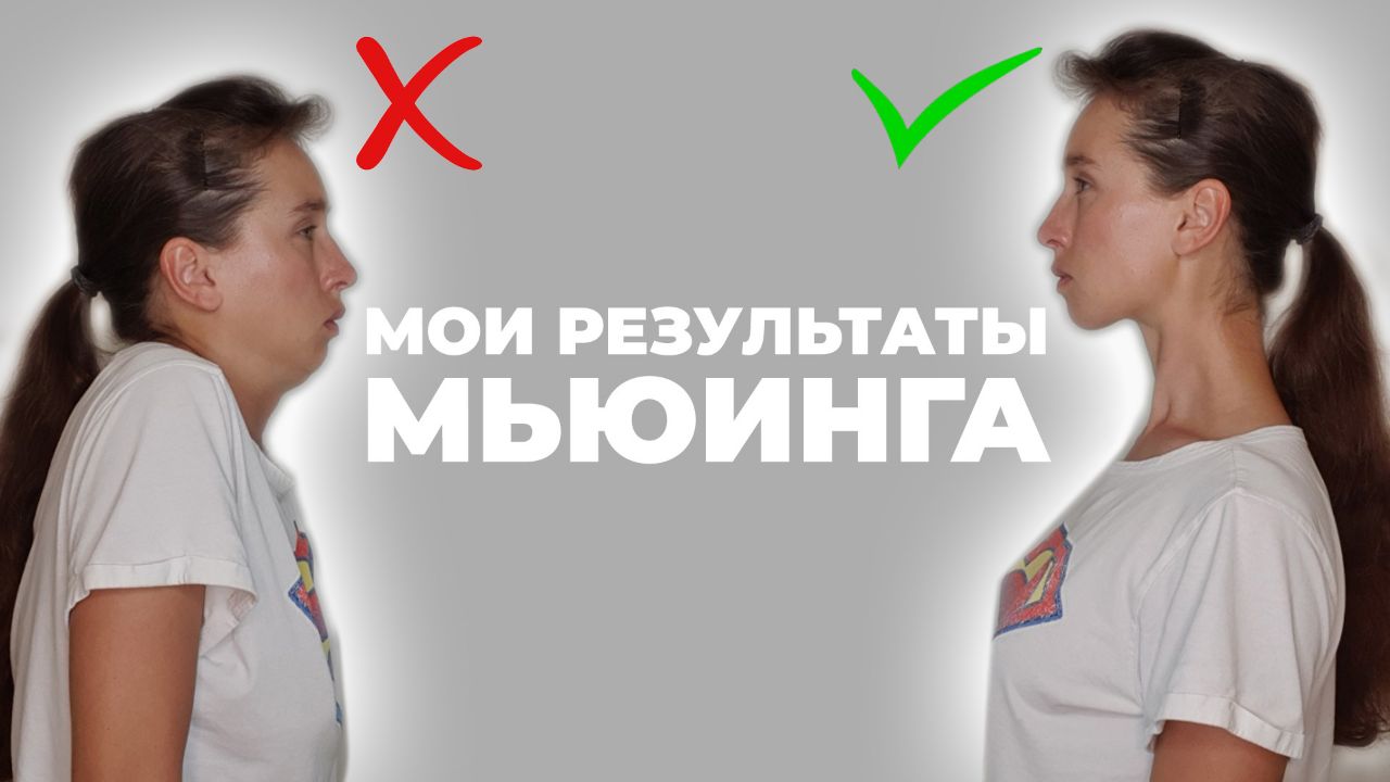 Изменил ли мьюинг моё лицо? Рассказываю, как я держу язык за зубами, чтобы  хорошеть | Стань краше с Орловой Дашей | Дзен