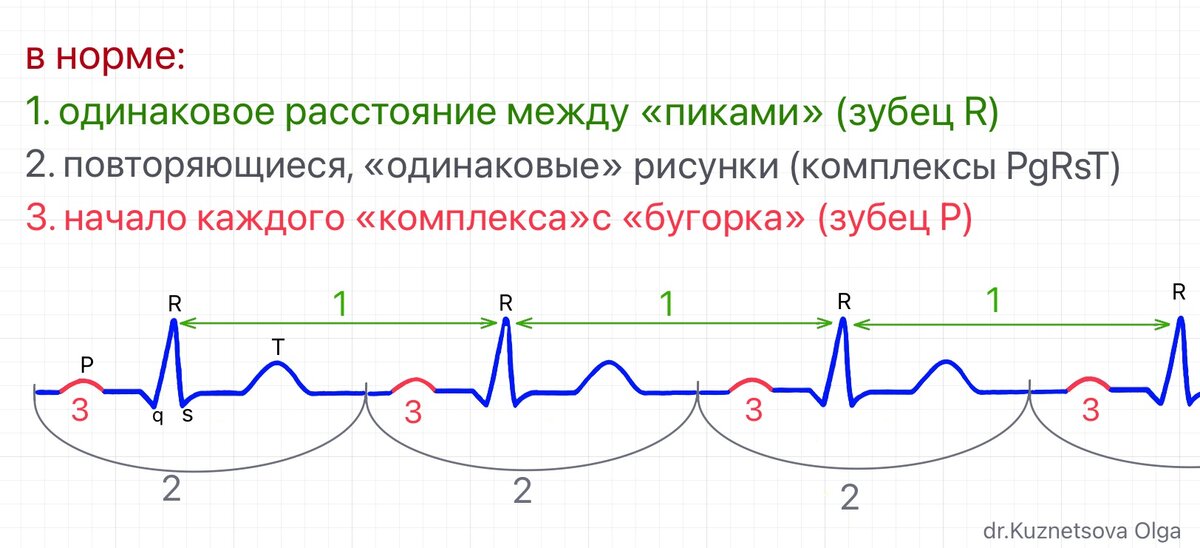 нормальная ЭКГ