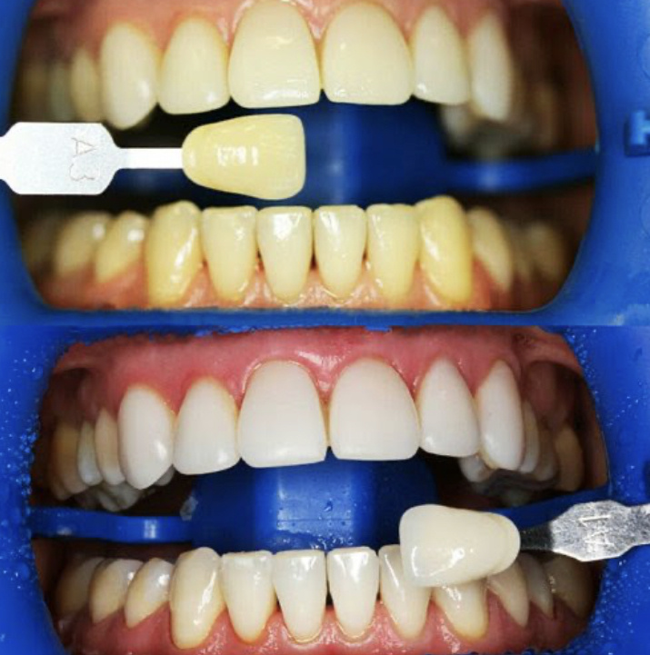 Кабинетное отбеливание системой Zoom на 7 тонов