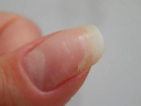 сломанный ноготь